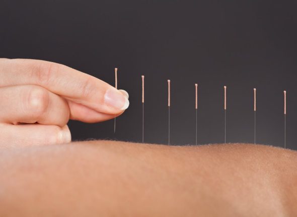 acupunctura