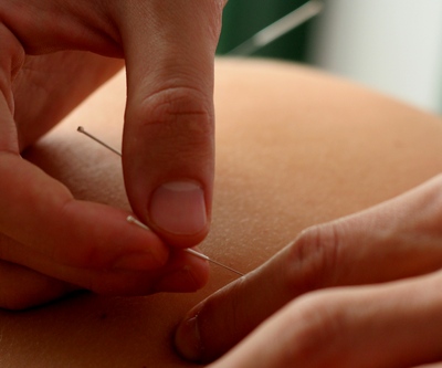 Acupunctura