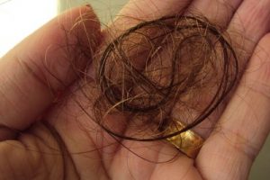 queda de cabelo gr